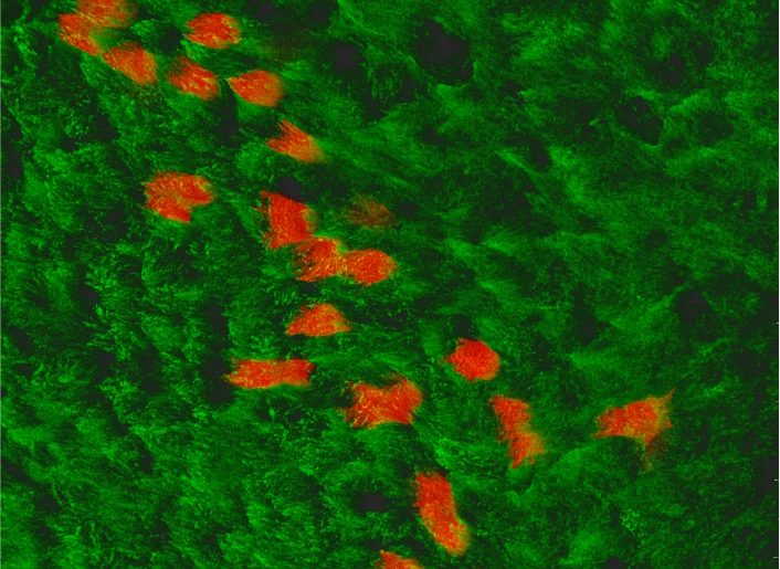SARS-CoV-2 infected airway cells, in red, among green epithelium